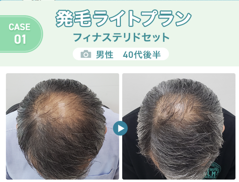 発毛ライトプラン：フィナステリドセット