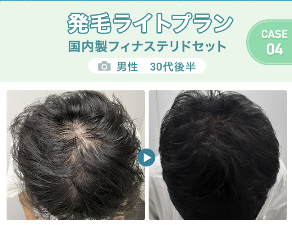 発毛ライトプラン（30代）：国内製フィナステリドセット